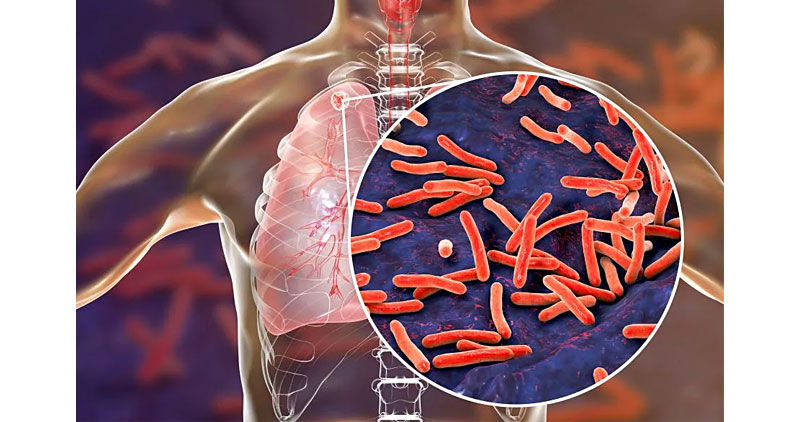 Diagram showing tuberculosis against human lung anatomy